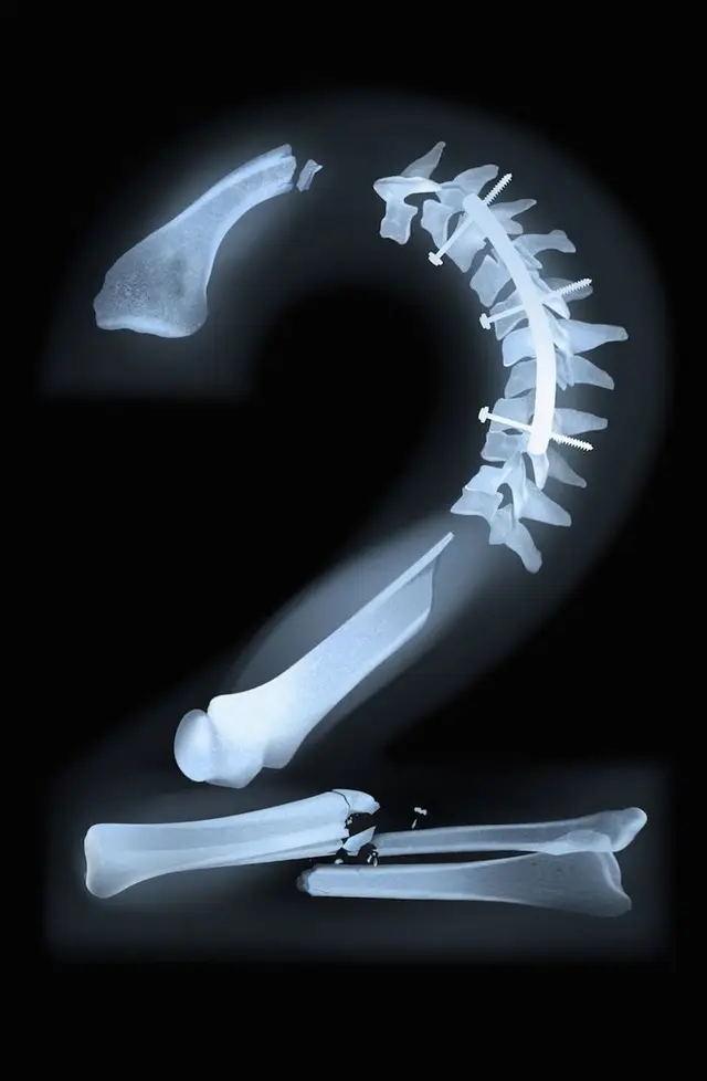 X-ray Numeral "2" — Bones with Spinal Fixation and Fracture