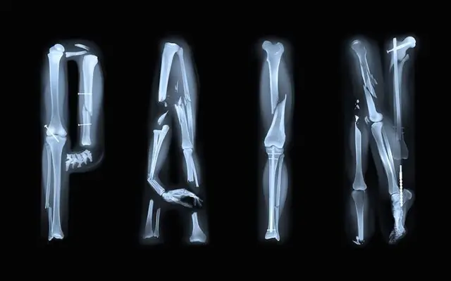 PAIN spelled with X-ray images of fractured long bones and implants